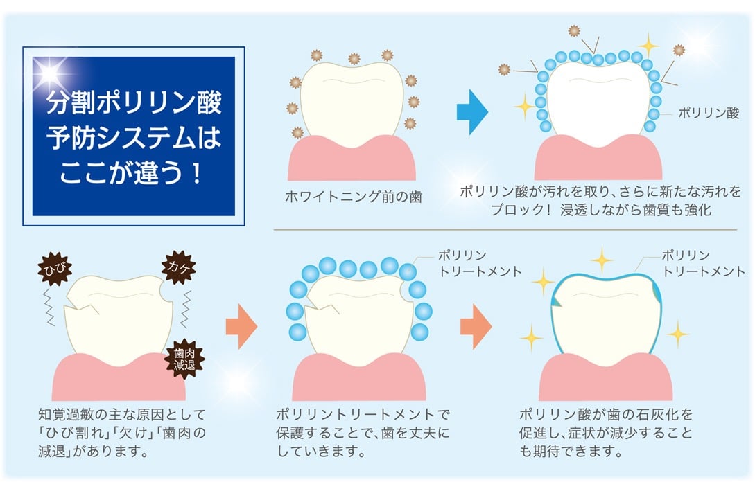 藤田歯科 豊中ステーションクリニックでホワイトニング