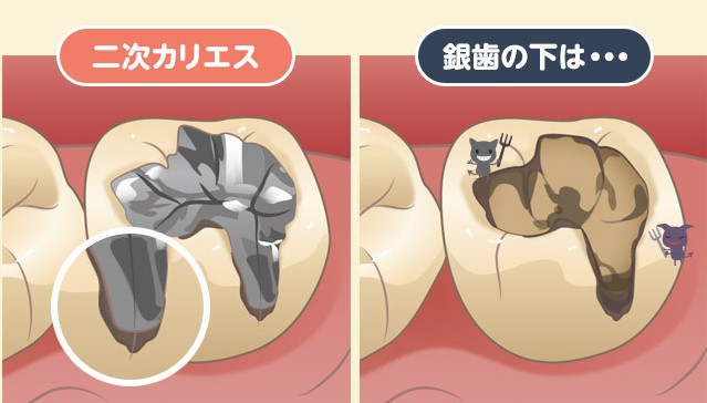 藤田歯科 豊中ステーションクリニックでセレック（CEREC）治療