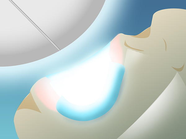 藤田歯科豊中ステーションクリニックのホワイトニング